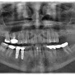 Case No. 1 - Maxillary Sinus Lift with Bone Graft and Implant Placement Pre-op missing maxillary left molars
