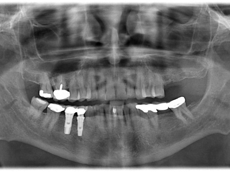 Case No. 1 - Maxillary Sinus Lift with Bone Graft and Implant Placement Pre-op missing maxillary left molars