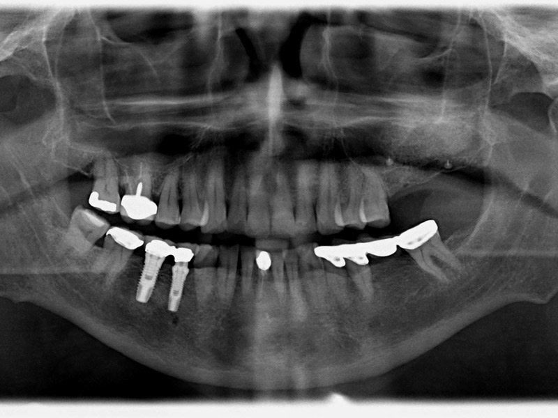 Case No. 1 - Maxillary Sinus Lift with Bone Graft and Implant Placement Immediate post op following sinus floor bone graft
