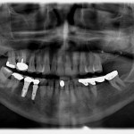 Case No. 1 - Maxillary Sinus Lift with Bone Graft and Implant Placement Immediate post op following sinus floor bone graft