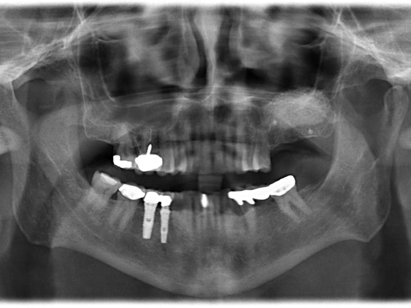 Case No. 1 - Maxillary Sinus Lift with Bone Graft and Implant Placement Final bone graft healing at six months