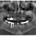 Case No. 1 - Maxillary Sinus Lift with Bone Graft and Implant Placement Final bone graft healing at six months