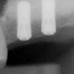 Case No. 1 - Maxillary Sinus Lift with Bone Graft and Implant Placement Implants placement to replace maxillary left molars