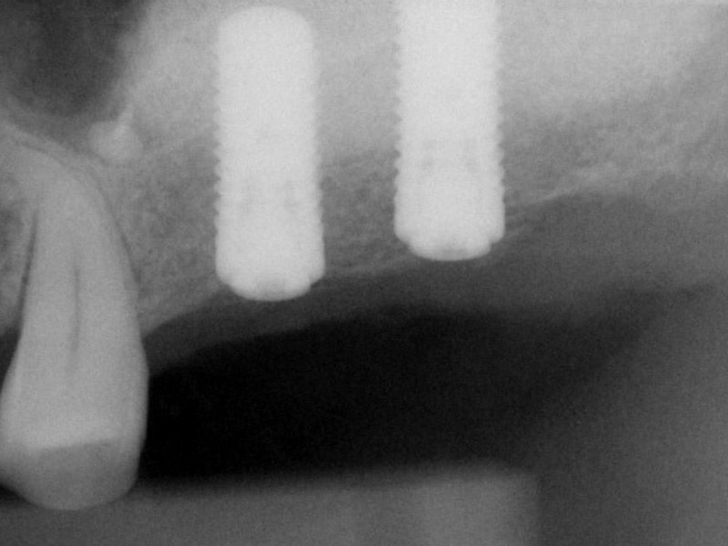 Case No. 1 - Maxillary Sinus Lift with Bone Graft and Implant Placement Implants placement to replace maxillary left molars