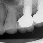 Case No. 1 - Maxillary Sinus Lift with Bone Graft and Implant Placement Final implant restorations