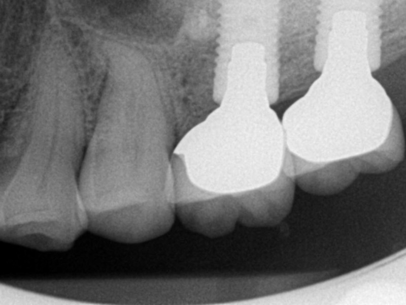 Case No. 1 - Maxillary Sinus Lift with Bone Graft and Implant Placement Final implant restorations