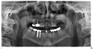 Sinus Lift X-Ray image