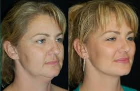 Before and After Buccal Fat Pad Excision