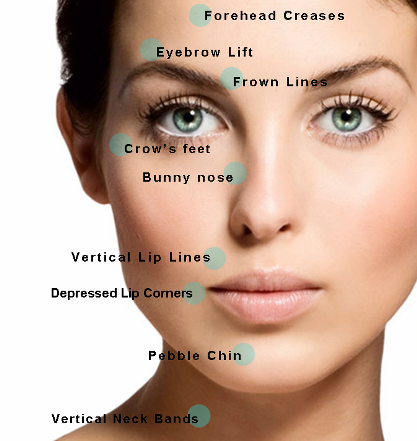 Facial diagram showing how Botox can be used to treat different parts of the face