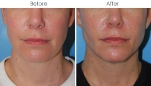 Before and After Buccal Fat Pad Excision