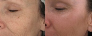 Before and After CO2-fractional Laser Treatment