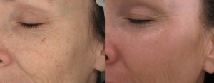 Before and After CO2-fractional Laser Treatment