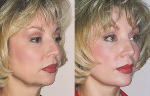 Before and After Genioplasty Chin Implant