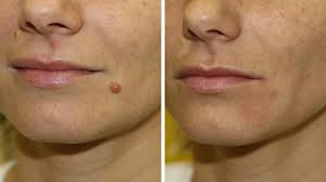 Before and After Mole Removal