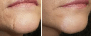 Before and After Facial Scar Removal