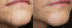 Before and After Facial Scar Removal