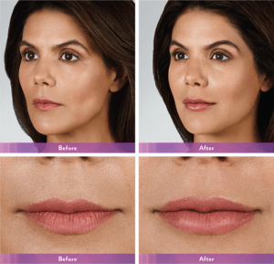 Before and After Lip Enhancement