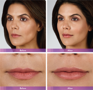 Before and After Lip Enhancement