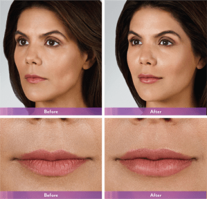 Before and After Lip Enhancement