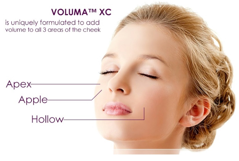 Juvederm™ VOLUMA XC is uniquely formulated to add volume to all 3 areas of the cheek.
