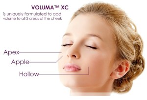 Juvederm VOLUMA XC treatment for areas of the face