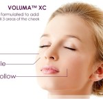 Juvederm™ VOLUMA XC is uniquely formulated to add volume to all 3 areas of the cheek.