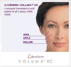 Juvederm Voluma treatment for face and cheeks
