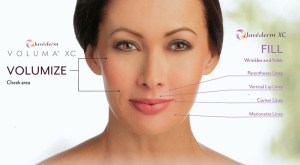 Areas of the face treated with Juvederm Facial Fillers