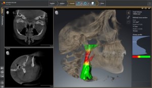 SICAT upper airway scan