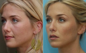 Before and After Cheek Augmentation Surgery, Malar Augmentation