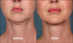 Before and After Kybella Treatment to Reduce Double Chin