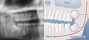 An representation of a tooth impacted by soft tissue